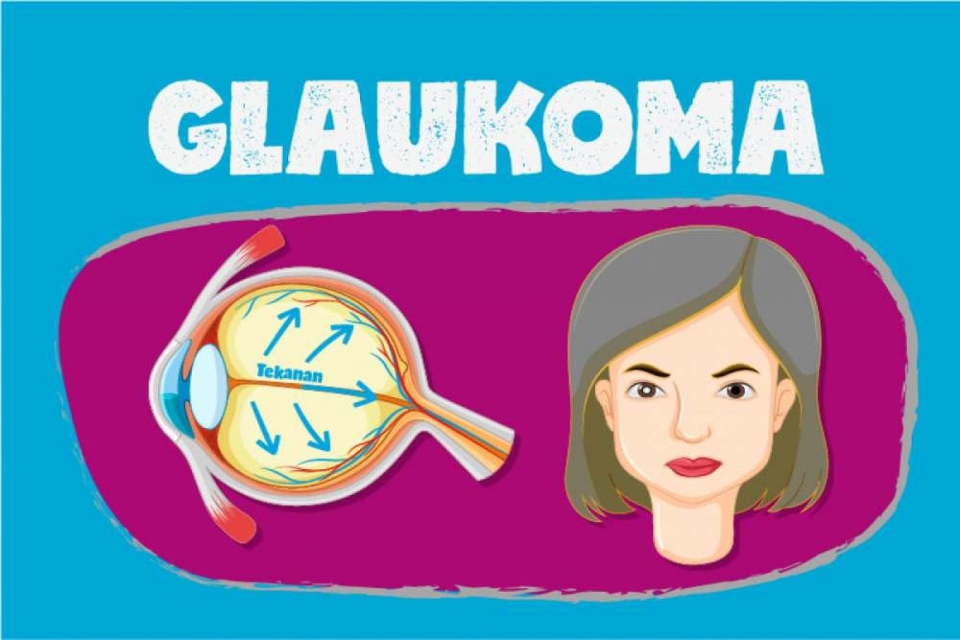Ini 6 Gejala Awal Glaukoma yang Wajib Diwaspadai dan Siapa Paling Risiko