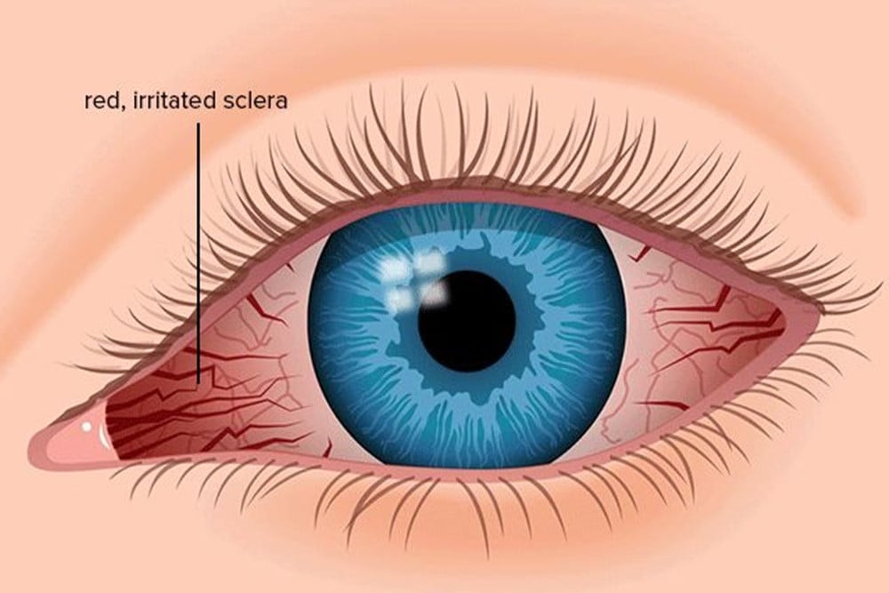 Waspada Uveitis: Gangguan Mata Merah yang Berisiko Sebabkan Kebutaan
