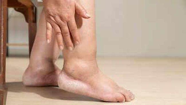 5 Penyakit Serius dengan Gejala Kaki Bengkak yang Wajib Diwaspadai Segera