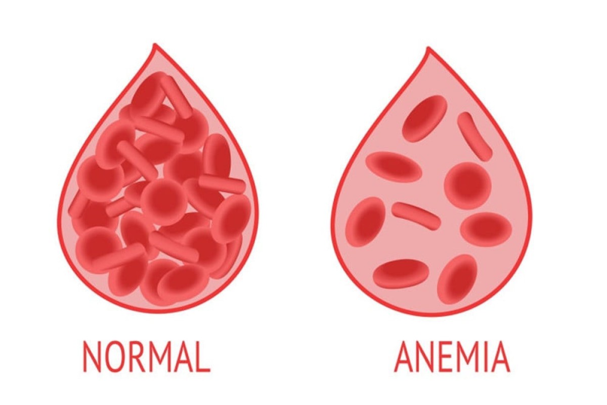 Kenali Gejala dan Penyebab Anak Alami Anemia Defisiensi Besi Secara Mudah Kenali Gejala dan Penyebab Anak Alami Anemia Defisiensi Besi Secara Mudah