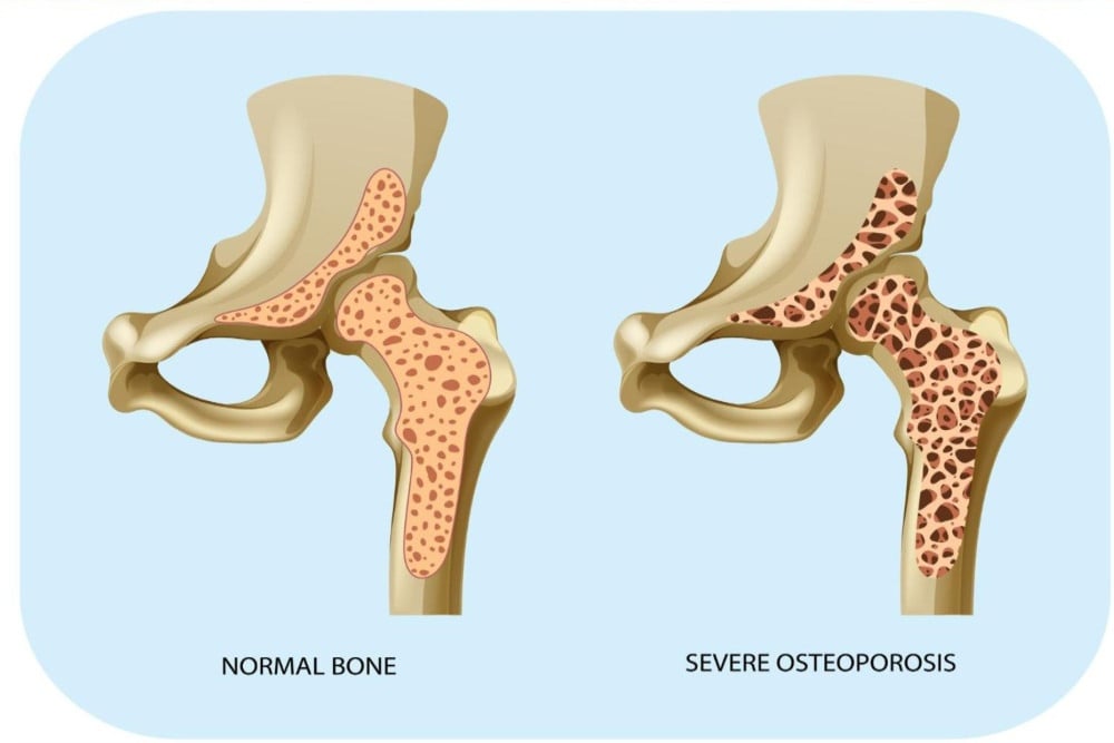 Kenali 5 Tanda Awal Osteoporosis, Cegah Tulang Keropos di Masa Tua Kenali 5 Tanda Awal Osteoporosis, Cegah Tulang Keropos di Masa Tua