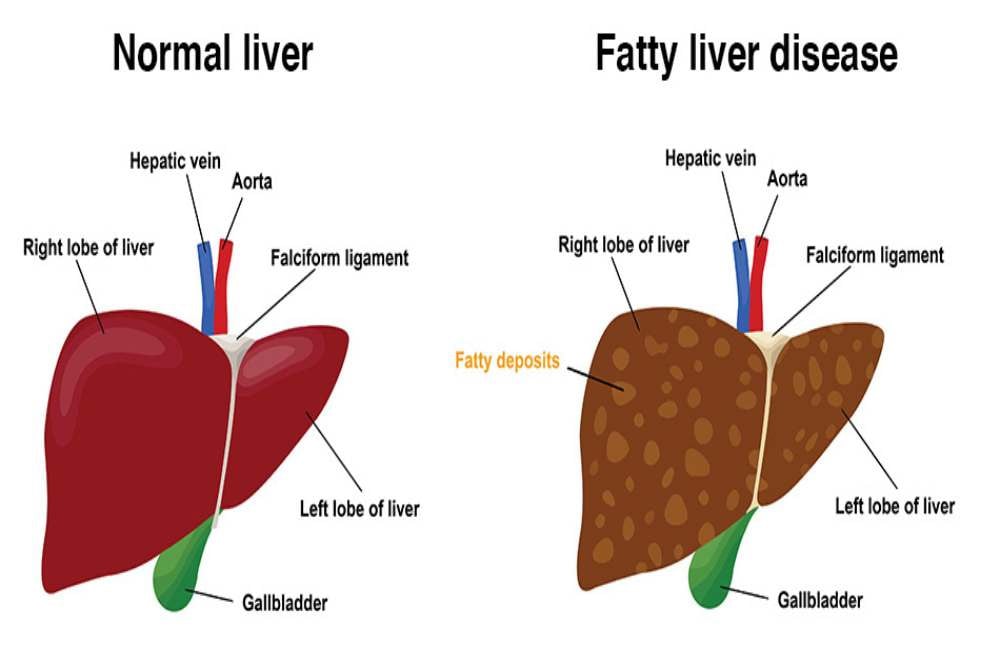 Ini 15 Makanan Ampuh untuk Detoks Liver Secara Alami dan Efektif
