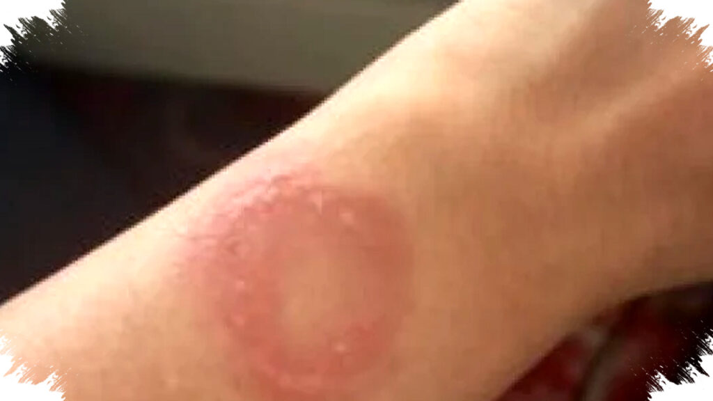 Apple Watch Panas Mendadak Picu Luka Bakar Permanen, Pengguna Terjebak Proses Apple Support Berbelit
