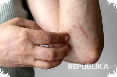 Kasus Campak Melonjak Drastis di Jabar, Dinkes Ingatkan Imunisasi Wajib Sebelum Mudik Lebaran untuk Cegah Penularan