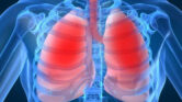 Lung Cryoablation Untuk Kanker Paru, Opsi Saat Operasi Tak Lagi Mungkin
