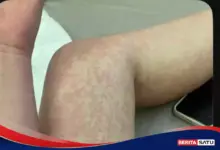 Penonton Tetap Datang Saat Campak, 3 Langkah Saat Anda Terpapar
